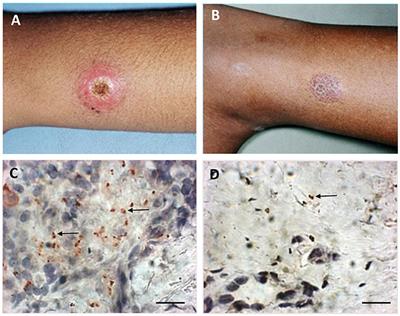 Leishmania Spp-Host Interaction: There Is Always an Onset, but Is There an End?